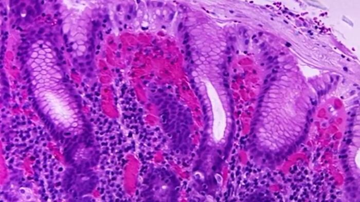 5th Florida death reported over rare Vibrio bacterial infection